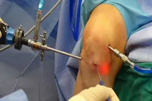 Orthopedics and joint replacement surgery at SAI Hospital - bone and joint specialist care